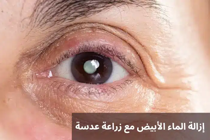 إزالة الماء الأبيض مع زراعة عدسة