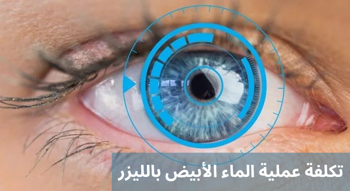 1000314102 تكلفة عملية الماء الأبيض بالليزر