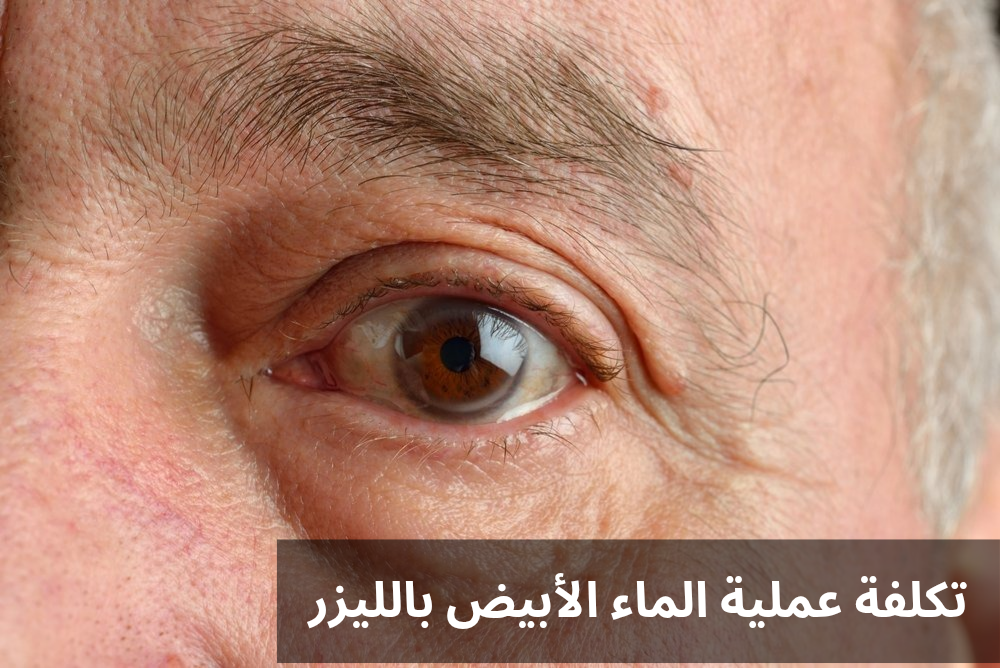 تكلفة عملية الماء الأبيض بالليزر
