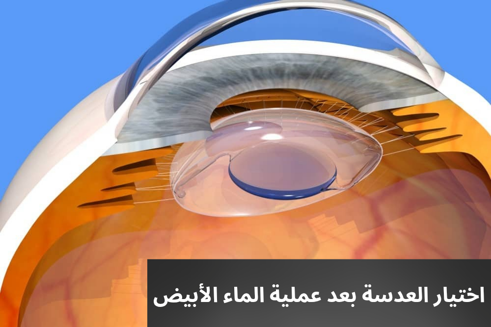 اختيار العدسة بعد عملية الماء الأبيض