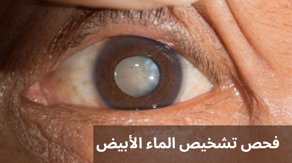 فحص تشخيص الماء الأبيض
