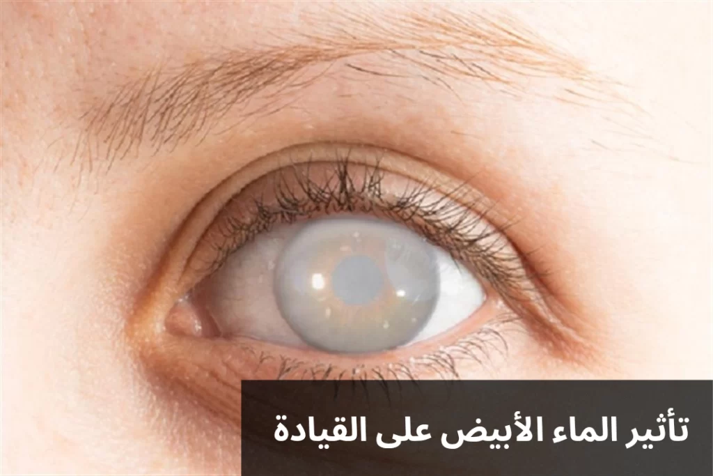 1000315256 تأثير الماء الأبيض على القيادة