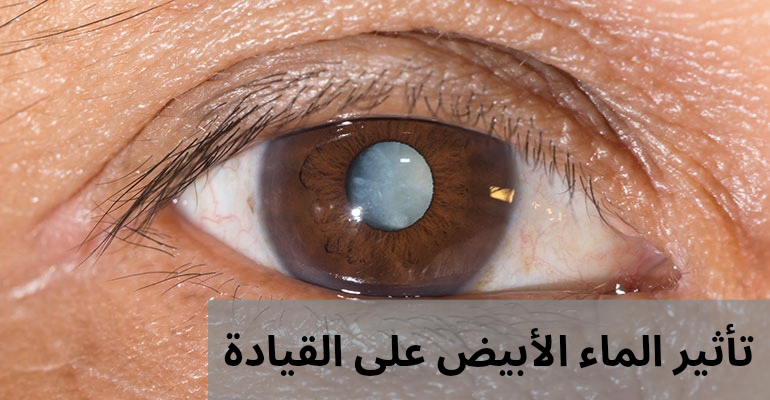 1000315257 تأثير الماء الأبيض على القيادة