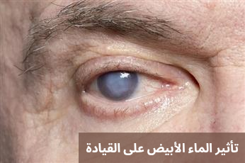 تأثير الماء الأبيض على القيادة
