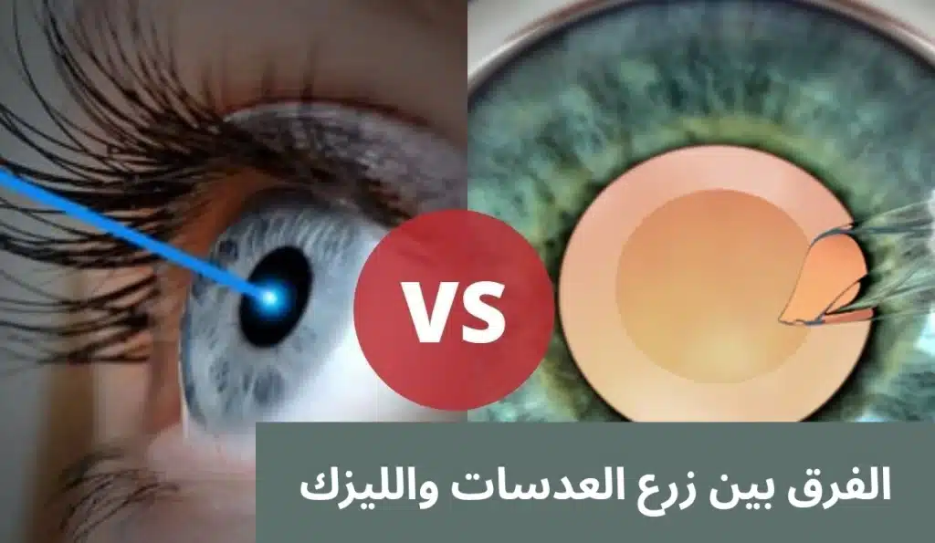 1000319063 الفرق بين زرع العدسات والليزك