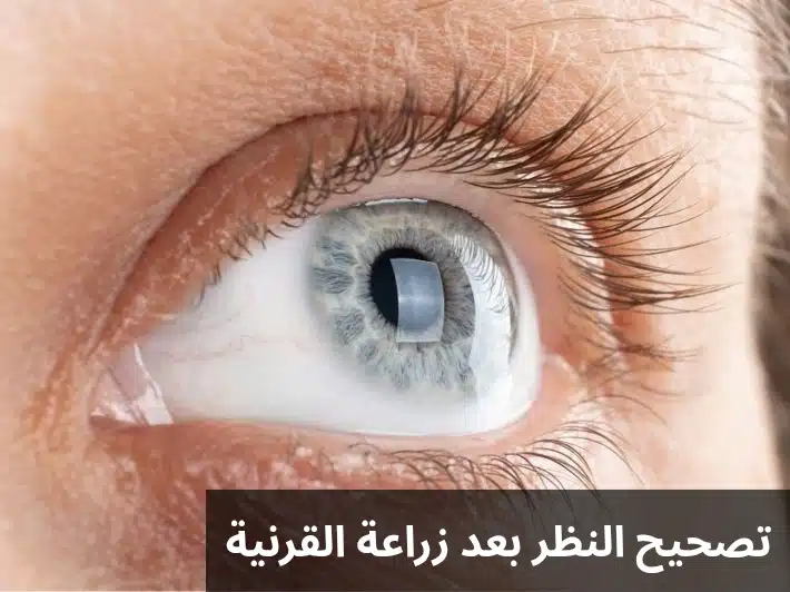 1000322788 تصحيح النظر بعد زراعة القرنية