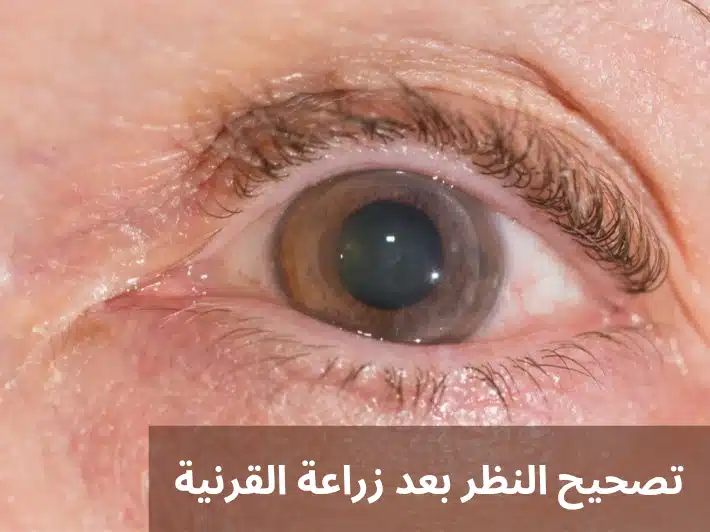 1000322789 تصحيح النظر بعد زراعة القرنية