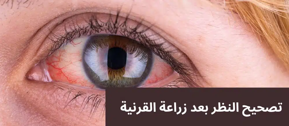 تصحيح النظر بعد زراعة القرنية
