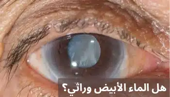 1000327154 هل الماء الأبيض وراثي؟