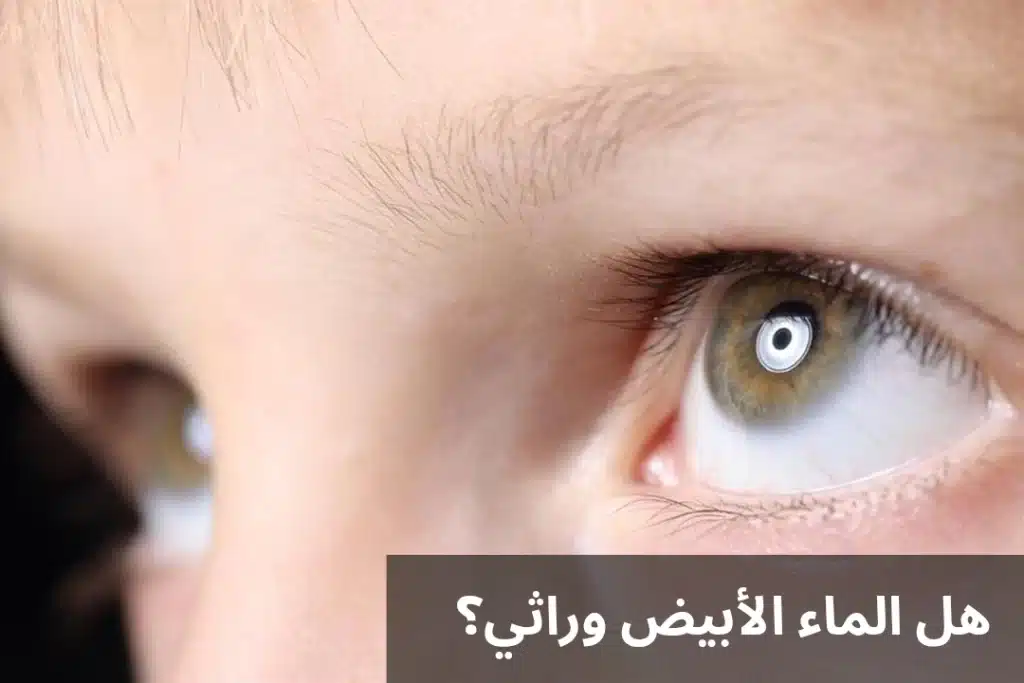 هل الماء الأبيض وراثي؟
