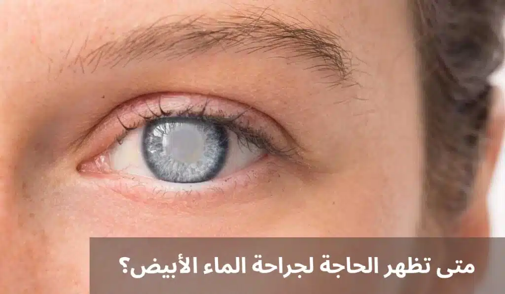 1000328495 متى تظهر الحاجة لجراحة الماء الأبيض؟