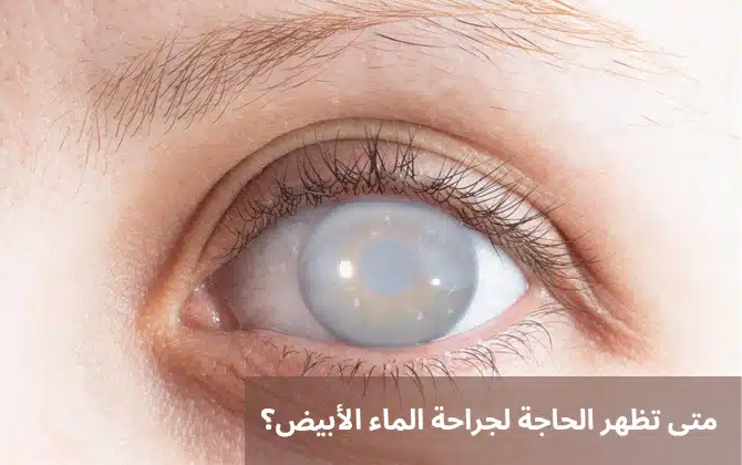 1000328496 متى تظهر الحاجة لجراحة الماء الأبيض؟