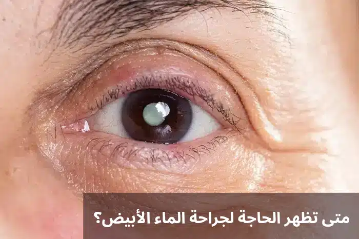 متى تظهر الحاجة لجراحة الماء الأبيض؟