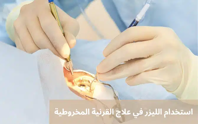 1000329365 استخدام الليزر في علاج القرنية المخروطية