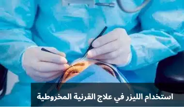 استخدام الليزر في علاج القرنية المخروطية