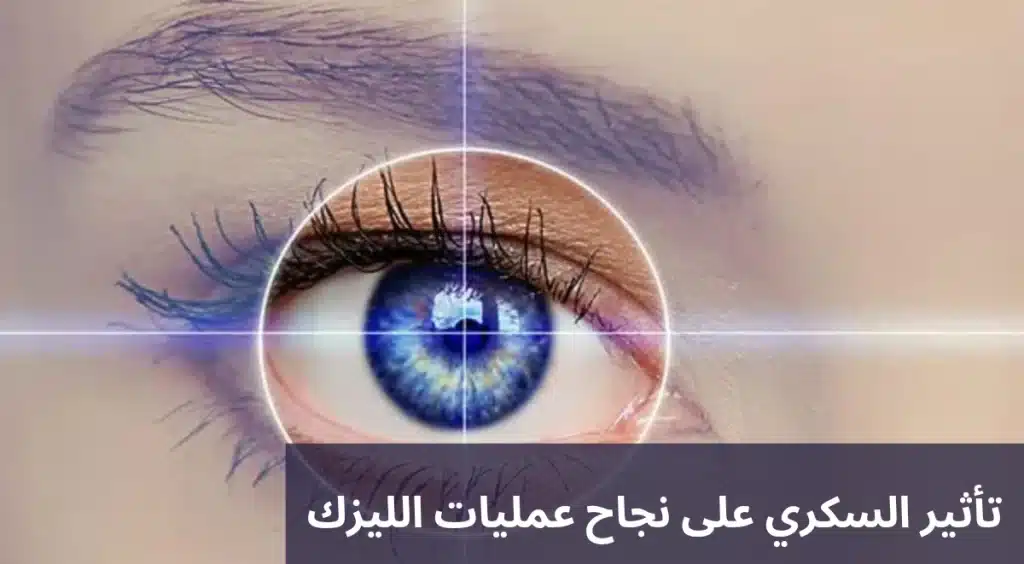 1000332528 تأثير السكري على نجاح عمليات الليزك