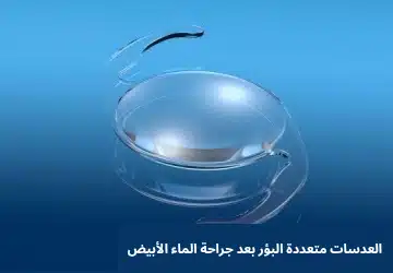 1000334788 العدسات متعددة البؤر بعد جراحة الماء الأبيض