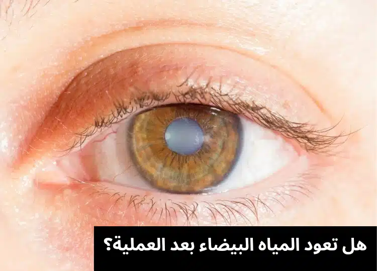 1000336345 هل تعود المياه البيضاء بعد العملية؟