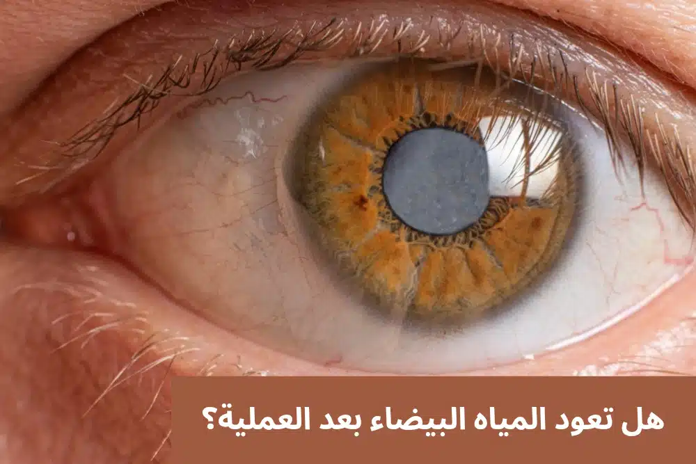 هل تعود المياه البيضاء بعد العملية؟
