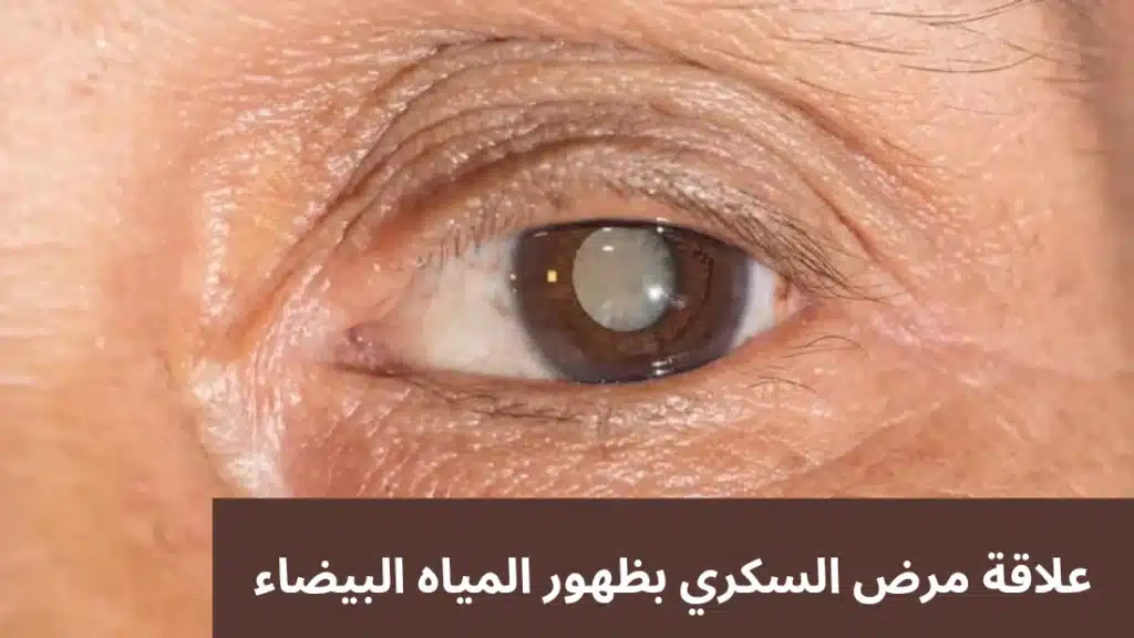 1000345655 علاقة مرض السكري بظهور المياه البيضاء