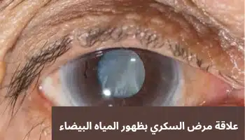 1000345656 علاقة مرض السكري بظهور المياه البيضاء