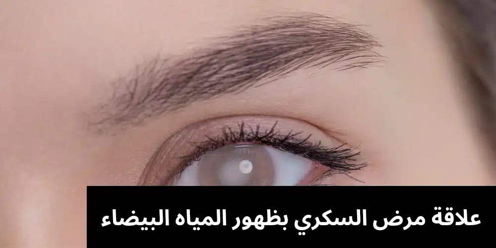 علاقة مرض السكري بظهور المياه البيضاء

