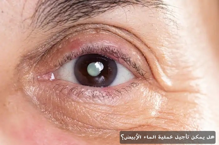 هل يمكن تأجيل عملية الماء الأبيض؟

