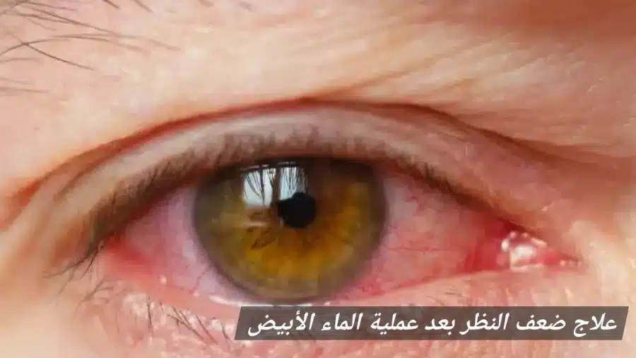 1000350841 علاج ضعف النظر بعد عملية الماء الأبيض