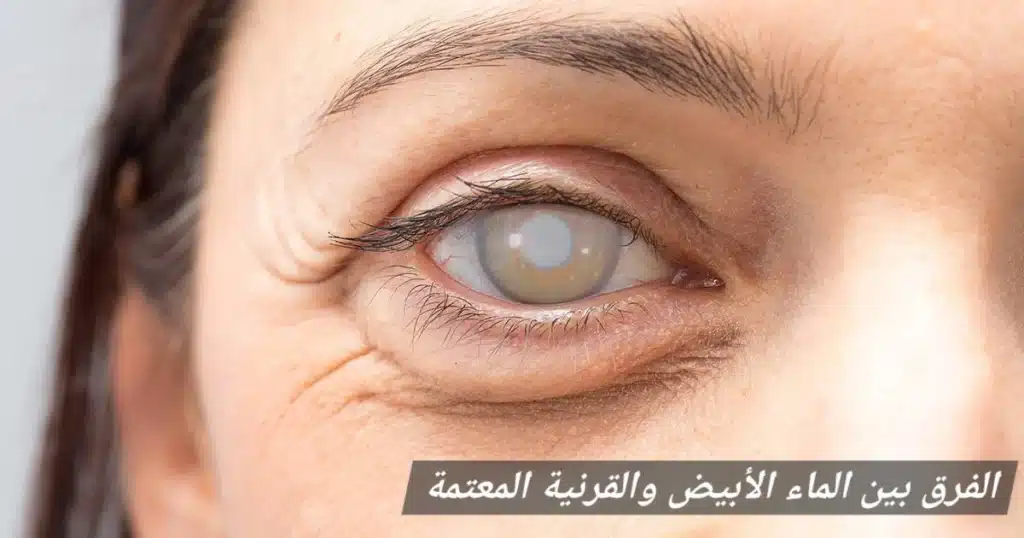 الفرق بين الماء الأبيض والقرنية المعتمة

