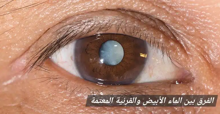 1000354490 الفرق بين الماء الأبيض والقرنية المعتمة