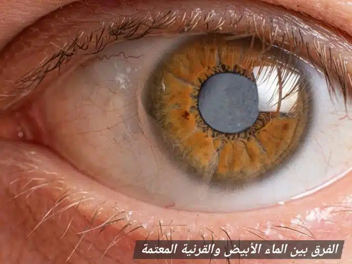 1000354491 الفرق بين الماء الأبيض والقرنية المعتمة