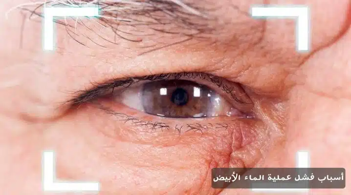 1000364935 أسباب فشل عملية الماء الأبيض