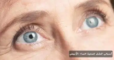 أسباب فشل عملية الماء الأبيض
