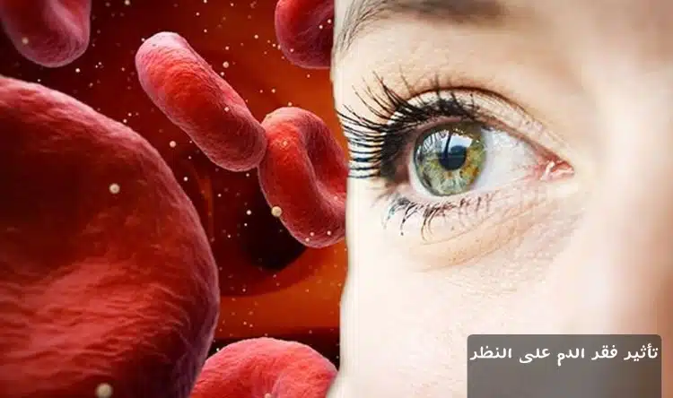 1000366656 تأثير فقر الدم على النظر
