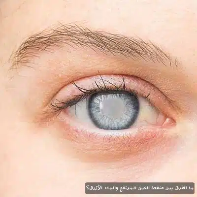 ما الفرق بين ضغط العين المرتفع والماء الأزرق؟

