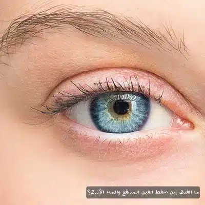 1000367429 ما الفرق بين ضغط العين المرتفع والماء الأزرق؟