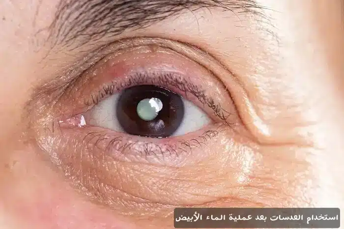 1000367943 استخدام العدسات بعد عملية الماء الأبيض