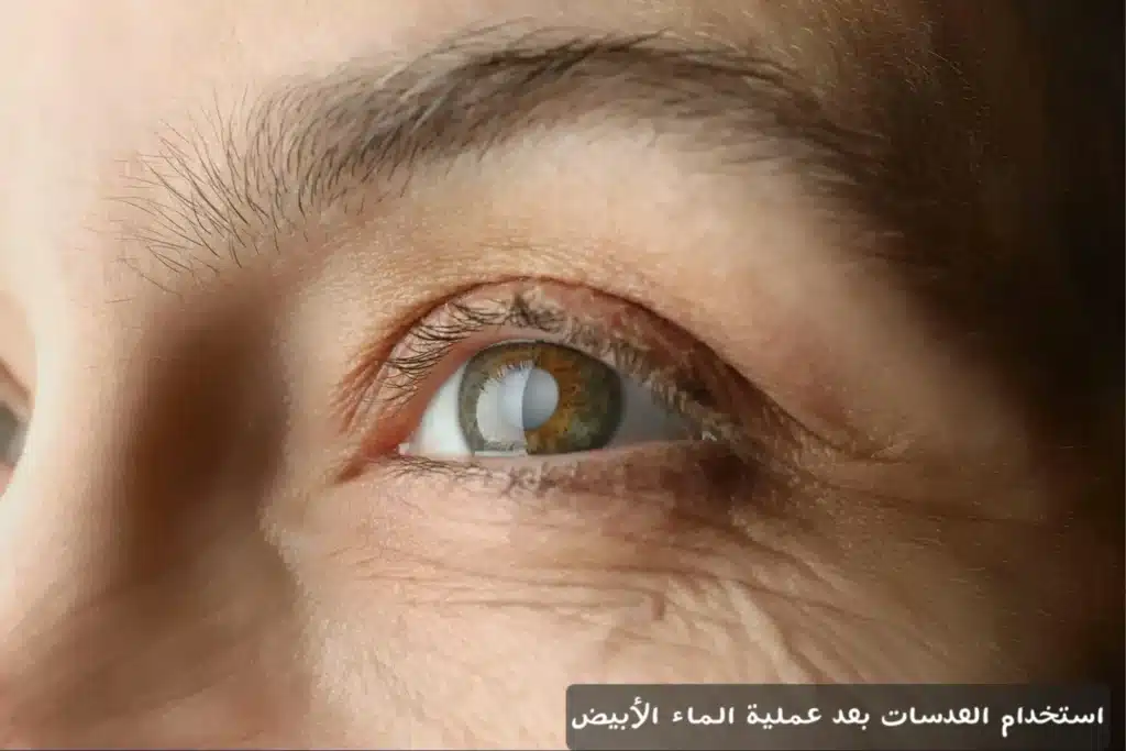 1000367944 استخدام العدسات بعد عملية الماء الأبيض