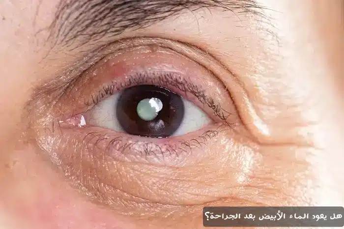 1000369429 هل يعود الماء الأبيض بعد الجراحة؟