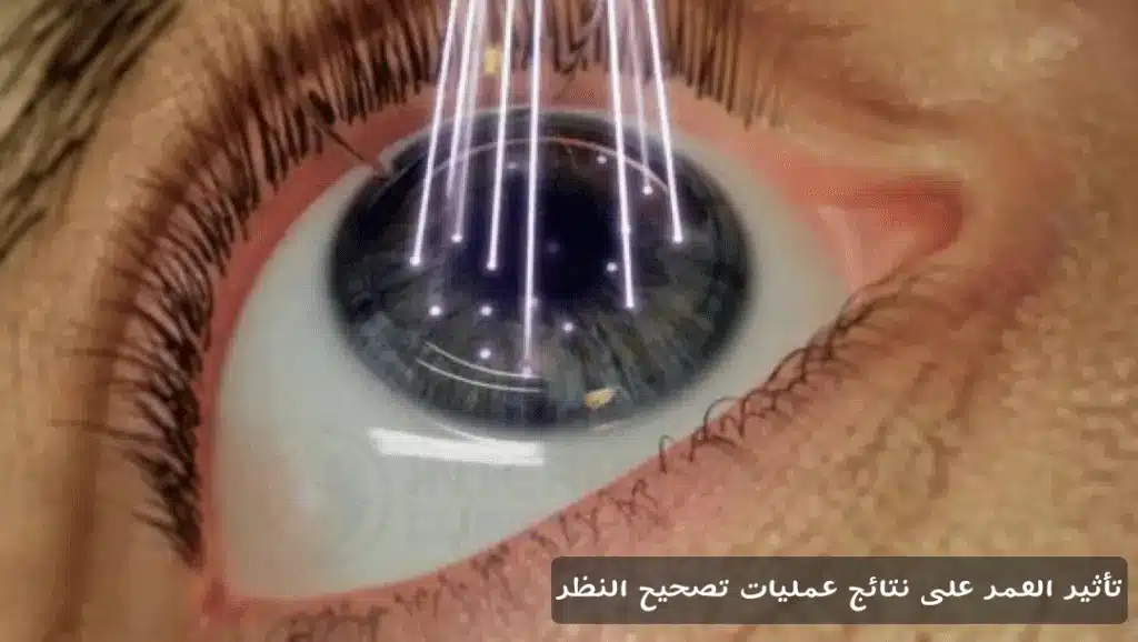 1000370563 تأثير العمر على نتائج عمليات تصحيح النظر