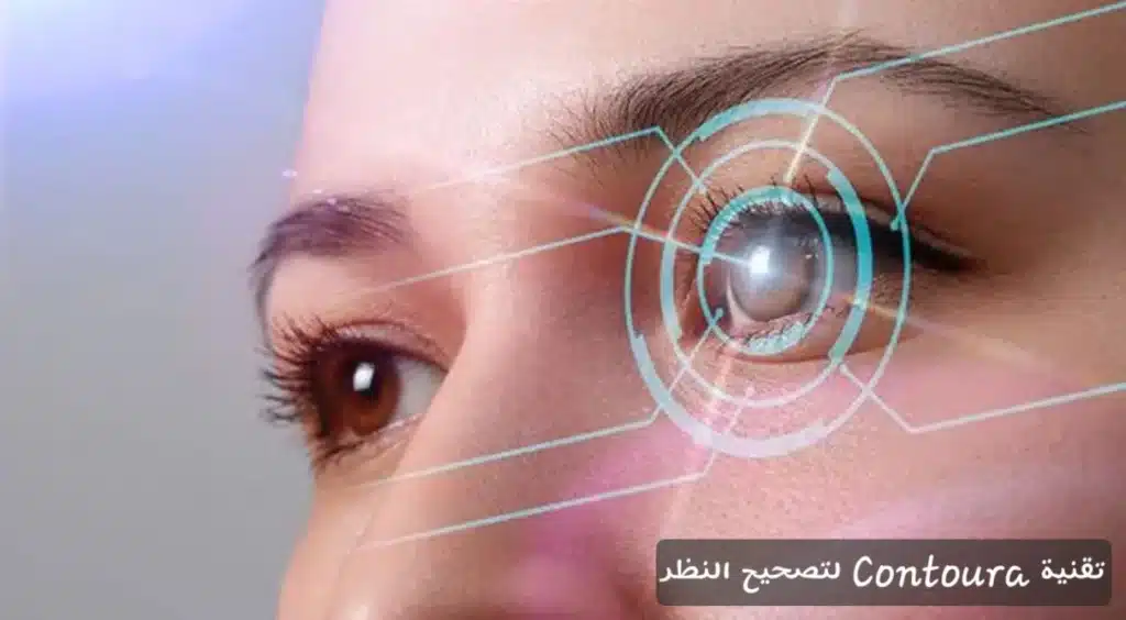 تقنية Contoura لتصحيح النظر
