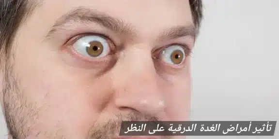 1000418641 تأثير أمراض الغدة الدرقية على النظر