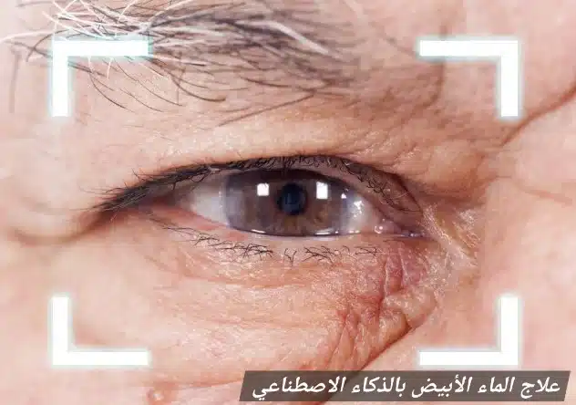 1000422683 علاج الماء الأبيض بالذكاء الاصطناعي