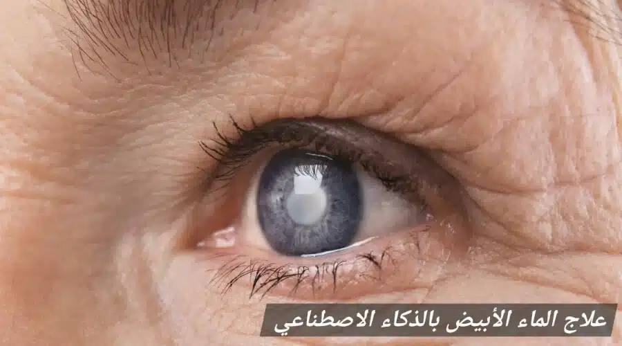 1000422684 علاج الماء الأبيض بالذكاء الاصطناعي