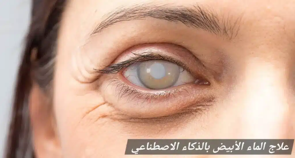 علاج الماء الأبيض بالذكاء الاصطناعي

