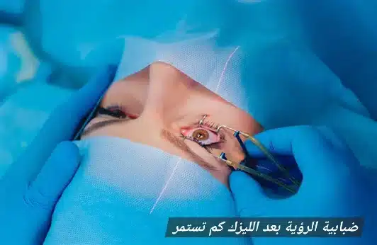 1000425533 ضبابية الرؤية بعد الليزك كم تستمر
