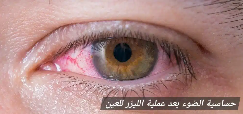 حساسية الضوء بعد عملية الليزر للعين
