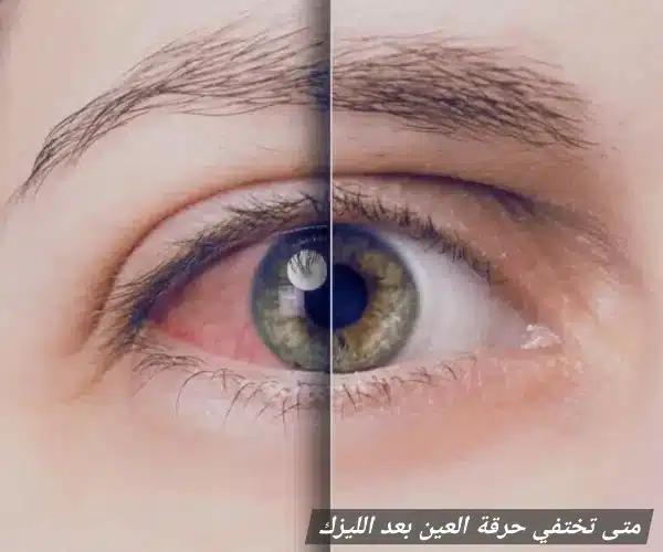 متى تختفي حرقة العين بعد الليزك