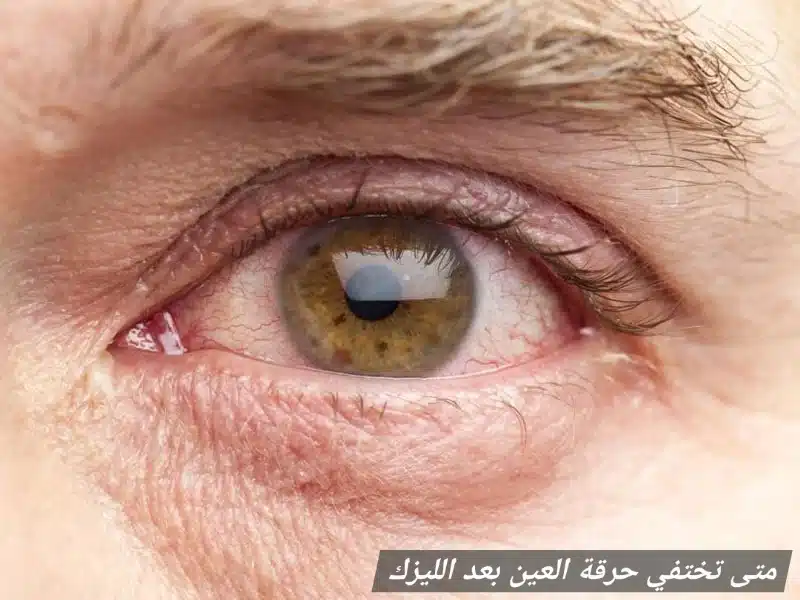 1000427458 متى تختفي حرقة العين بعد الليزك