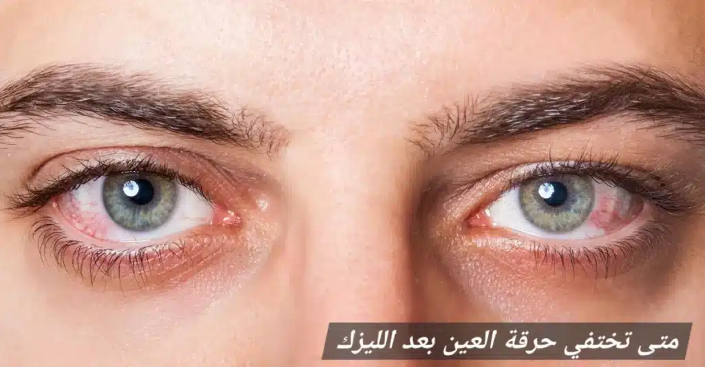 1000427459 متى تختفي حرقة العين بعد الليزك